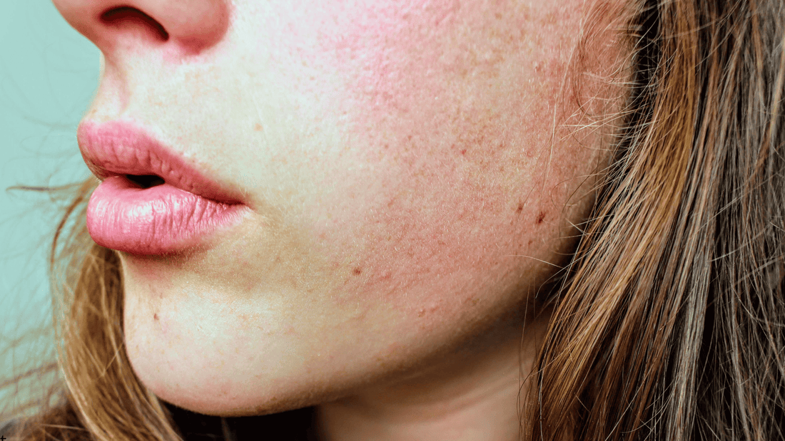Närbild på hud med stora porer före microneedling